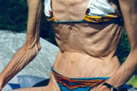 Anoreksiya kabusu