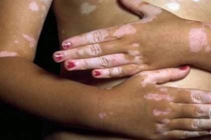 Stres vitiligoyu tetikliyor