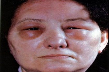 2 bin 700 kişi tanı konmazsa ölebilir