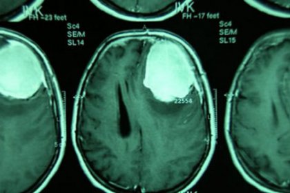 Beyin tümörü tedavisinde önemli adım