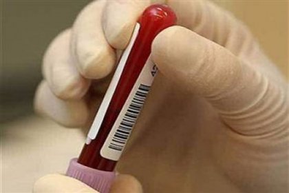 Down sendromuna erken ve kesin test