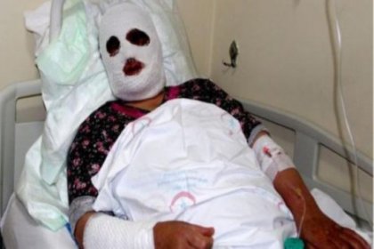 Lavabo açıcıya sıcak su döken kadının yüzü yandı