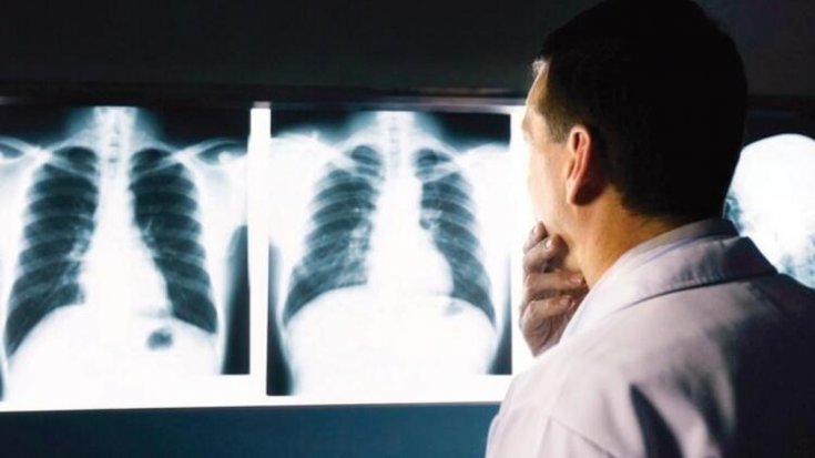Röntgen ile kanser riski arasında bağ tespit edildi