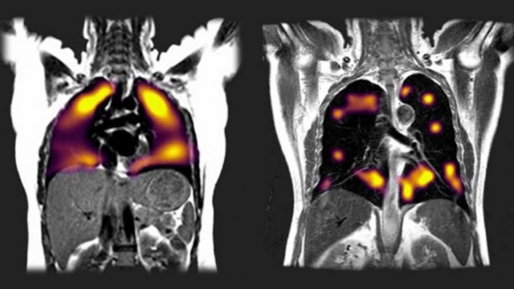 Yeni tarama tekniği, koronavirüsün akciğerlerde bıraktığı hasarı gösterdi