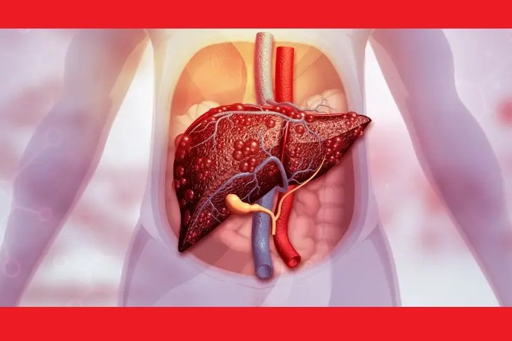 Karaciğer Yağlanması Nedir? Belirtileri, Nedenleri ve Tedavisi nedir? Karaciğer Yağlanması Nedir? Belirtileri, Nedenleri ve Tedavisi nedir?