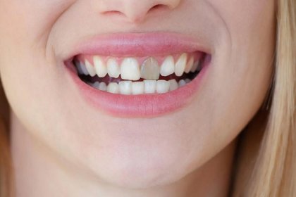 Dişlerde görülen renk değişiklikleri pek çok nedenden kaynaklanabilir!