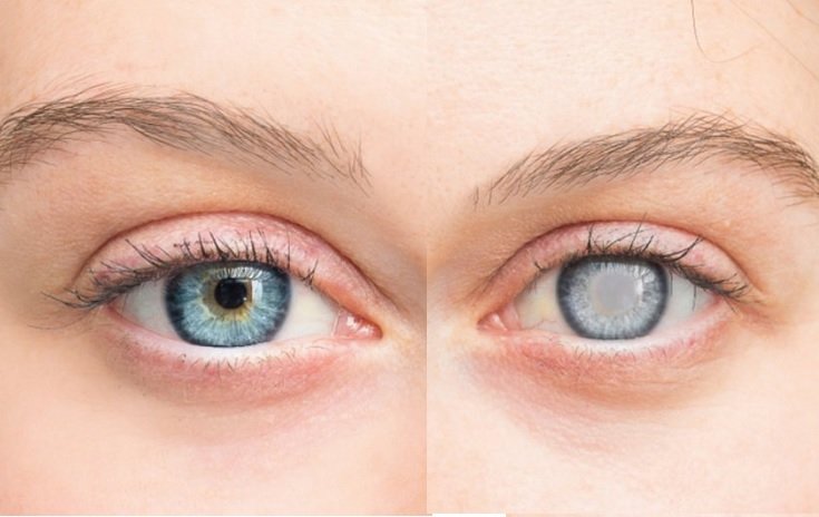 Katarakt nedir? Katarakt belirtileri ve nedenleri nedir?
