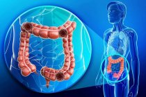 Genç yaşta kolon kanseri görülme sıklığı artıyor; Bağırsak duvarındaki sertleşme erken bir uyarı olabilir!