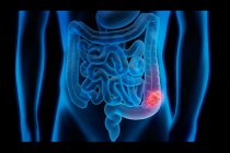 Kolon kanseri riskini artıran nedenlere dikkat!