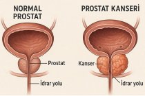 Prostat Nedir? Prostat Belirtileri Nelerdir?