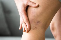 Varis Nedir? Varis Neden Olur, Belirtileri ve Tedavisi