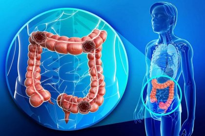 Genç yaşta kolon kanseri görülme sıklığı artıyor; Bağırsak duvarındaki sertleşme erken bir uyarı olabilir!