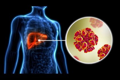 Hepatit sinsi ilerleyebiliyor! Hepatit hastaları bunlara dikkat etmeli?