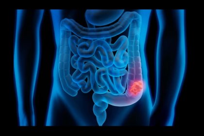 Kolon kanseri riskini artıran nedenlere dikkat!