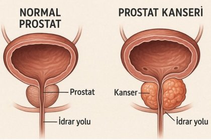 Prostat Nedir? Prostat Belirtileri Nelerdir?