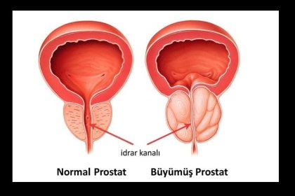 Prostat Nedir? Prostat Belirtileri Nelerdir?